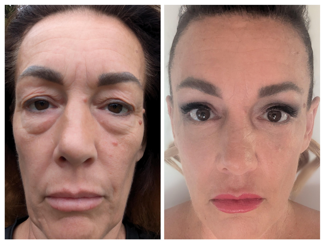 Extended Blepharoplasty